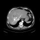 Liver metastases of carcinoid, embolization: CT - Computed tomography
